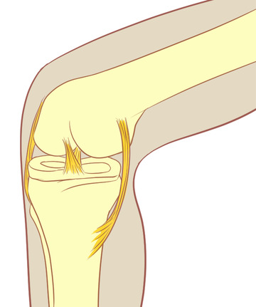 膝盖半月板损伤滑膜炎撕裂人骨结构手绘医学
