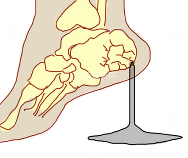 源文件下载【趣麦麦图】脚后跟疼脚麻腱鞘炎骨头医学插画钉子