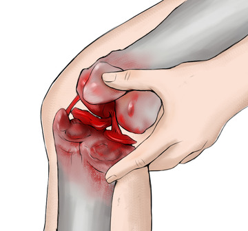 膝盖滑膜炎撕裂半月板损伤结构手绘医学插画