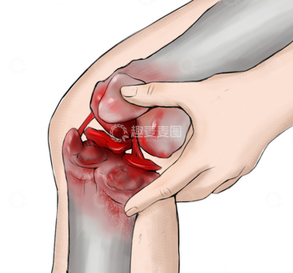 源文件下载【趣麦麦图】膝盖滑膜炎撕裂半月板损伤结构手绘医学插画