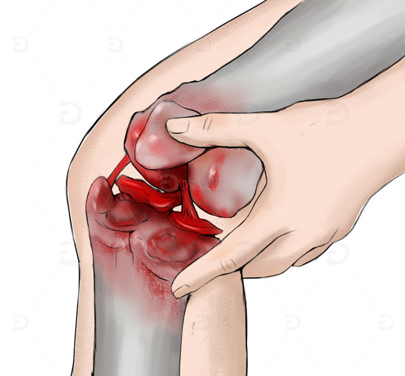 源文件下载【趣麦麦图】-膝盖滑膜炎撕裂半月板损伤结构手绘医学插画