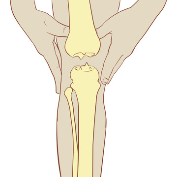 半月板损伤膝盖滑膜炎撕裂人骨结构手绘医学