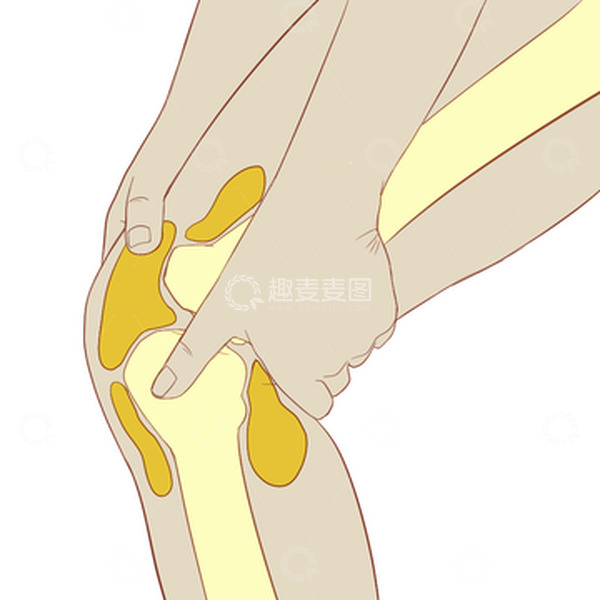 源文件下载【趣麦麦图】滑膜炎撕裂人骨结构手绘医学