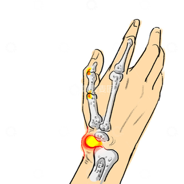 源文件下载【趣麦麦图】腱鞘炎手指腱鞘炎腱鞘疼痛