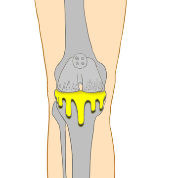 膝盖半月板损伤滑膜炎撕裂人骨结构医学手绘