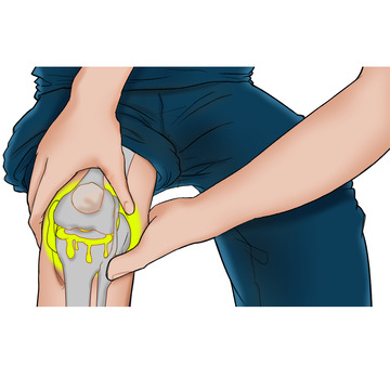 膝盖半月板损伤滑膜炎撕裂人骨结构医学插画