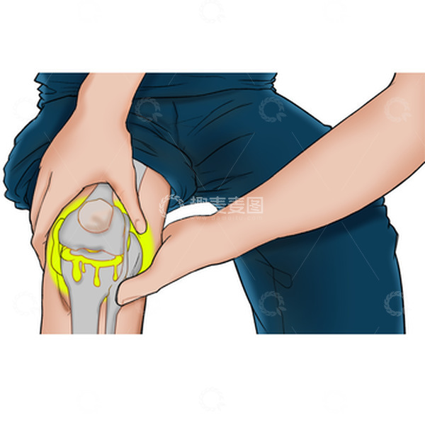 源文件下载【趣麦麦图】膝盖半月板损伤滑膜炎撕裂人骨结构医学插画
