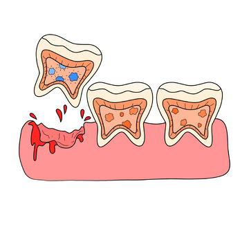 口腔牙齿疾病蛀牙