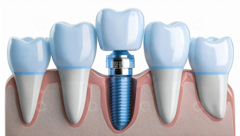 高清大图下载【趣麦麦图】种植牙模型展示牙齿修复过程