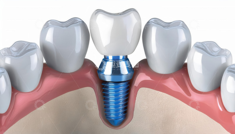 高清大图下载【趣麦麦图】牙齿模型展示种植牙的植入效果
