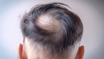 男性头顶稀疏状况