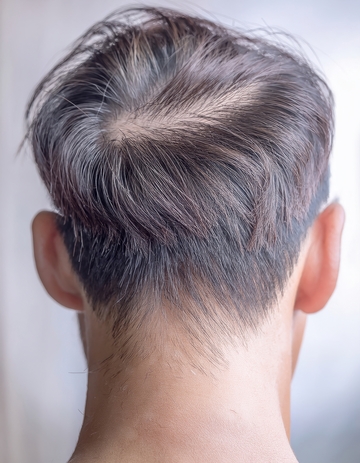 男性脑后头发稀疏状况呈现