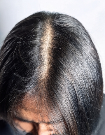 近景呈现头顶发缝状况