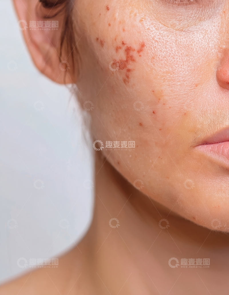 高清大图下载【趣麦麦图】女性脸颊痘痘近景