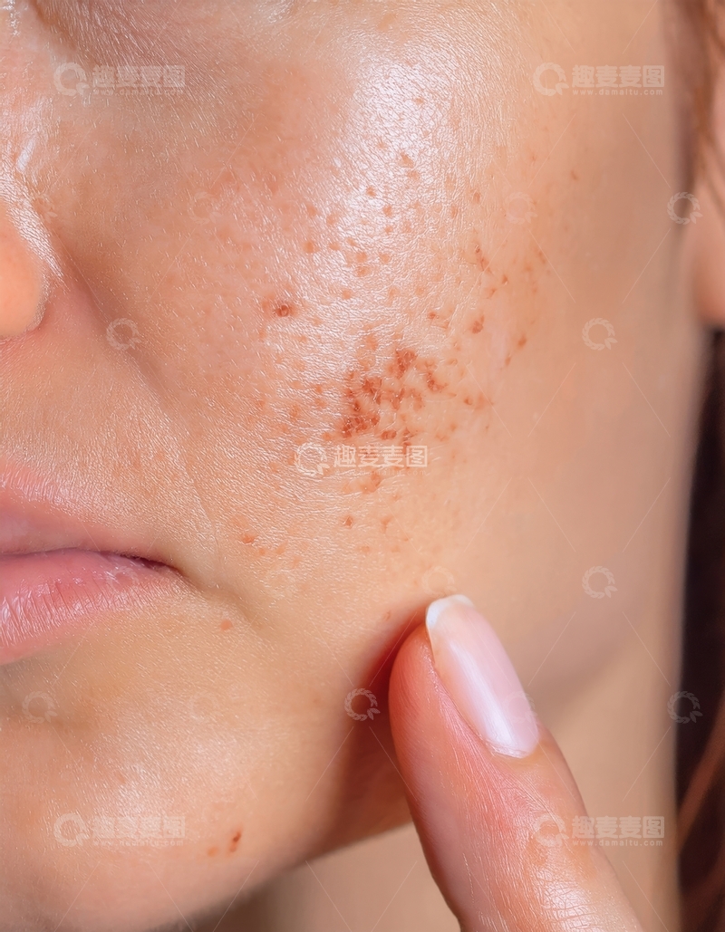 高清大图下载【趣麦麦图】女性脸部痘痘特写