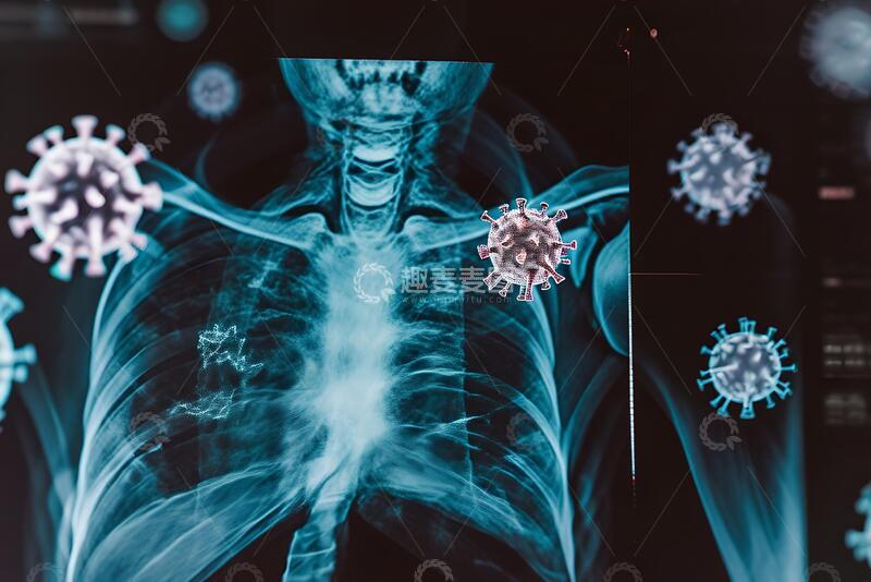 高清大图下载【趣麦麦图】新型冠状病毒肺炎胸部CT扫描