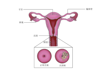 女性生殖系统与宫颈癌对比图医用插图