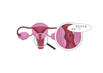 女性生殖系统及精子暂存示意医用插图