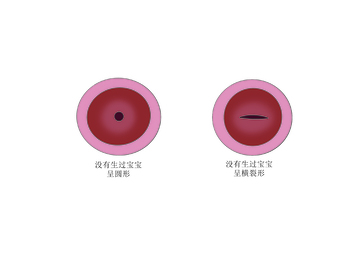 未生育女性不同形态示意图医用插图