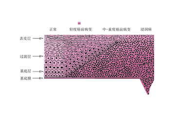 癌症病变示意图医学插画