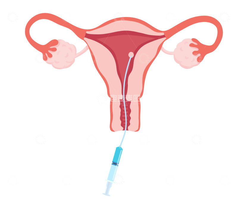 源文件下载【趣麦麦图】-女性子宫注射示意图辅助生殖医用插画
