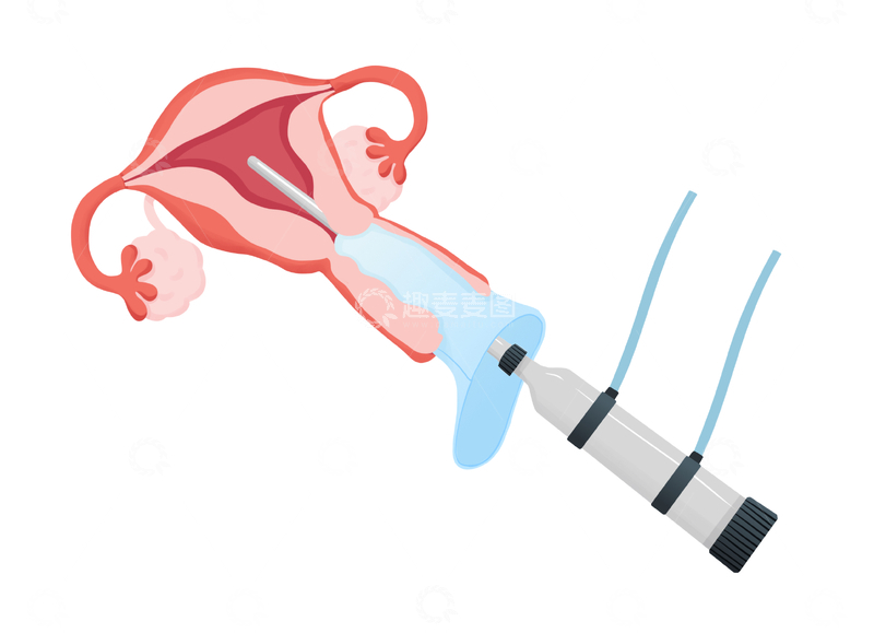 源文件下载【趣麦麦图】-女性子宫内窥镜检查示意图