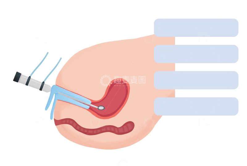 源文件下载【趣麦麦图】-人工试管婴儿手术医疗插画图示